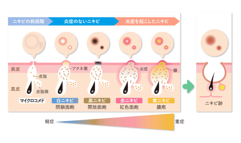 コメド（白ニキビ・黒ニキビ）ができる原因とは？ニキビの始まり「コメド」ができる仕組みと対処法を徹底解説 – 小林製薬の皮膚科学研究