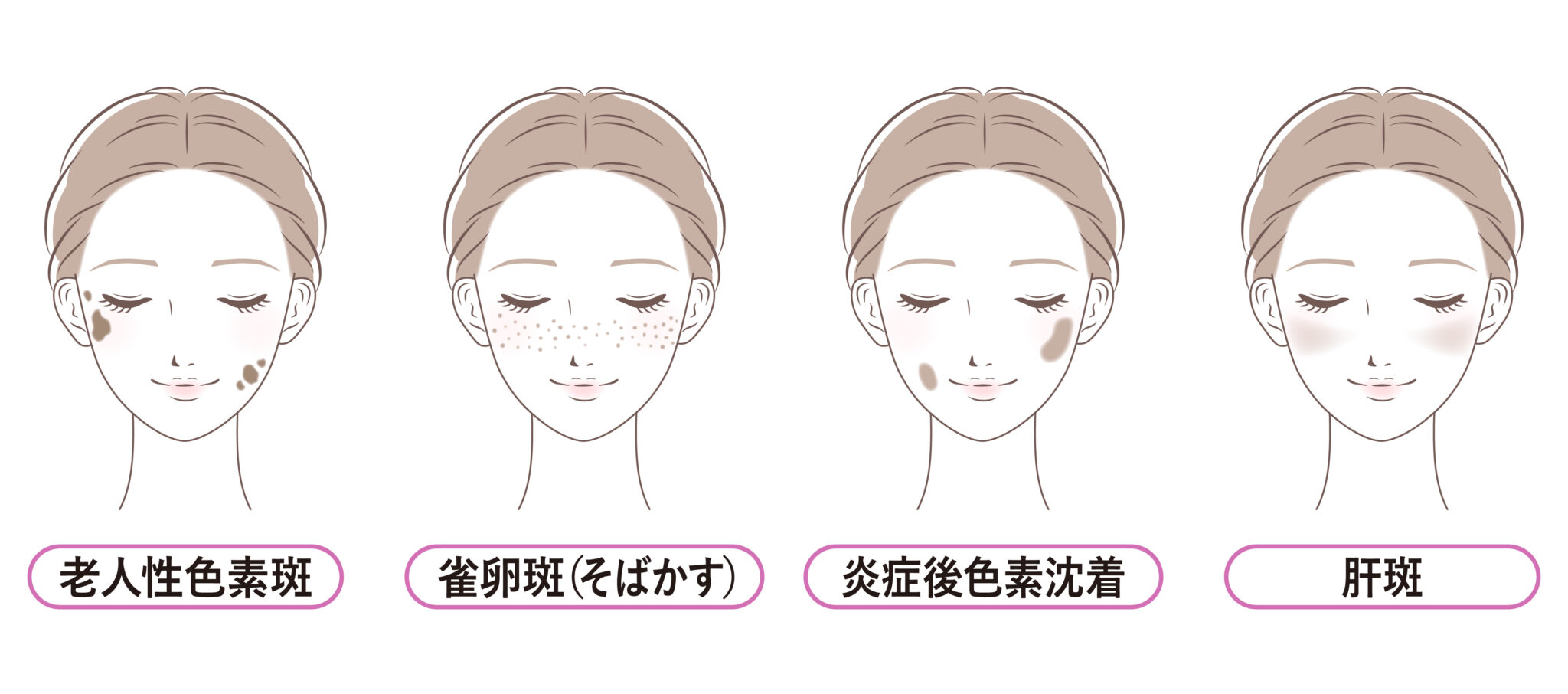 顔にできる「シミ」の原因は？【男性】と【女性】で異なる 要因を徹底解説！ – 小林製薬の皮膚科学研究
